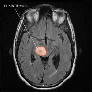 brain cancer, diffuse glioma